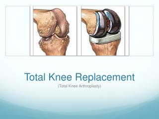 Total Knee Replacement