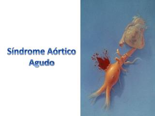 Síndrome Aórtico Agudo