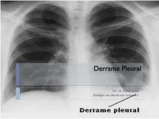 Derrame Pleural