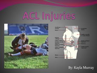 ACL Injuries