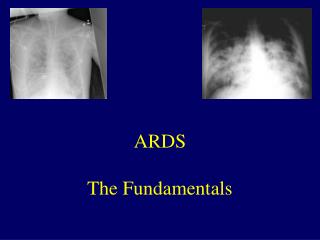 ARDS The Fundamentals