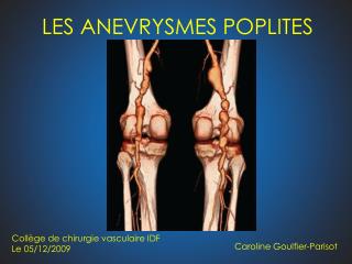 LES ANEVRYSMES POPLITES