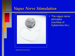 Vagus Nerve Stimulation