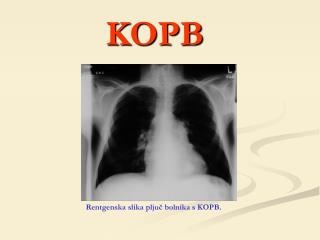 Rentgenska slika pljuč bolnika s KOPB.