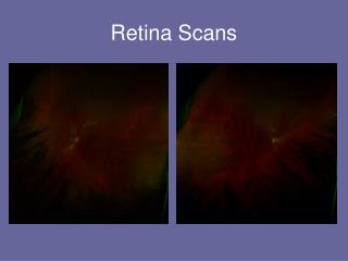 Retina Scans