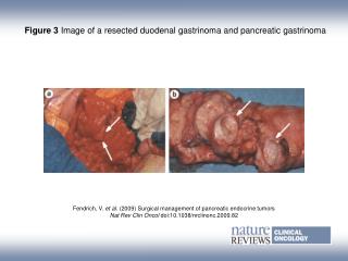 Figure 3 Image of a resected duodenal gastrinoma and pancreatic gastrinoma
