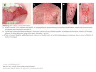 Schmidt, Enno; Zillikens , Detlef Diagnostik und Therapie bullöser Autoimmundermatosen