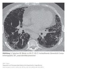 Behr, Jürgen Diagnostik und Therapiemöglichkeiten bei idiopathischer Lungenfibrose