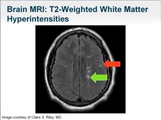 Diagnostic Criteria for RIS