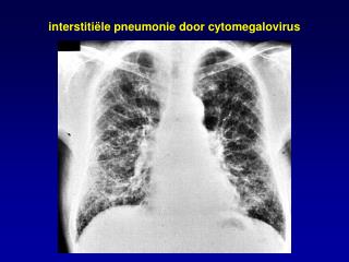 interstiti ë le pneumonie door cytomegalovirus