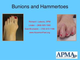 Bunions and Hammertoes