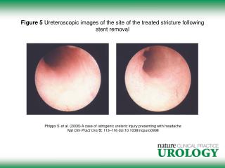 Figure 5 Ureteroscopic images of the site of the treated stricture following stent removal