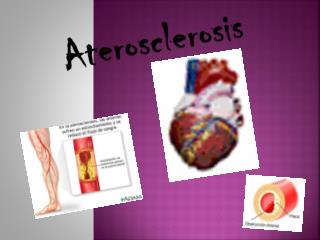 Aterosclerosis