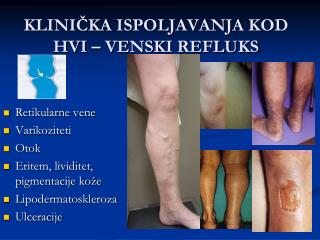 KLINIČKA ISPOLJAVANJA KOD HVI – VENSKI REFLUKS