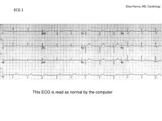 ECG 1