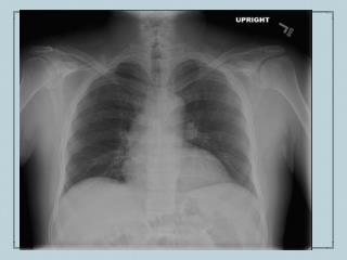 Strongyloides stercoralis in transplant patients