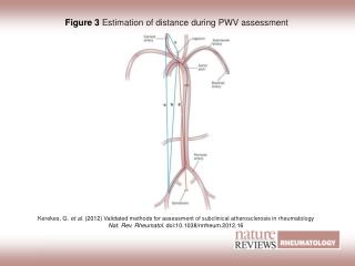 Figure 3 Estimation of distance during PWV assessment