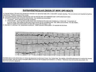 NNA SITE-Supraventricular Origin of Wide QRS Beats