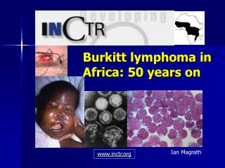 Burkitt lymphoma in Africa: 50 years on