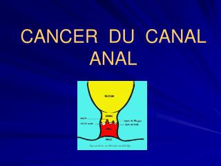 CANCER DU CANAL ANAL