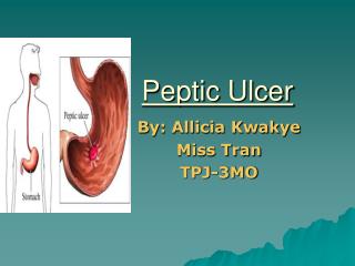 Peptic Ulcer