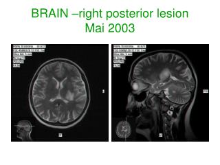 BRAIN –right posterior lesion Mai 2003