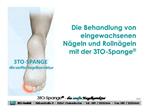 Die Behandlung von eingewachsenen N geln und Rolln geln mit der 3TO-Spange