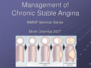 Management of Chronic Stable Angina