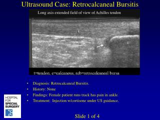 Ultrasound Case: Retrocalcaneal Bursitis