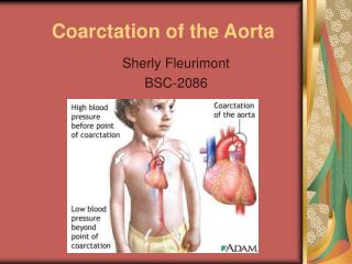 Coarctation of the Aorta