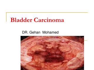 Bladder Carcinoma