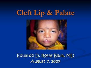 Cleft Lip &amp; Palate