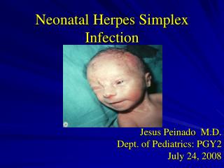 Neonatal Herpes Simplex Infection