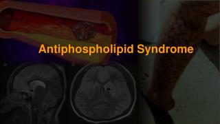 Antiphospholipid Syndrome