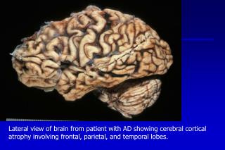 Lateral view of brain from patient with AD showing cerebral cortical