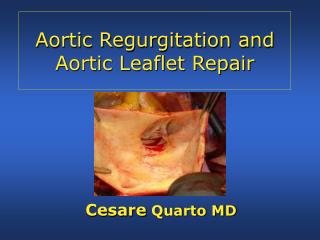 Aortic Regurgitation and Aortic Leaflet Repair