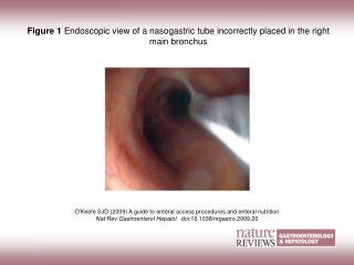 Figure 1 Endoscopic view of a nasogastric tube incorrectly placed in the right main bronchus