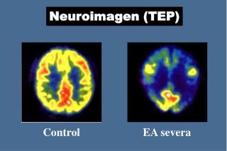 Neuroimagen (TEP)