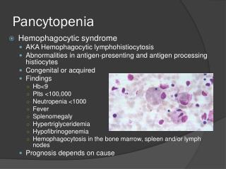 Pancytopenia