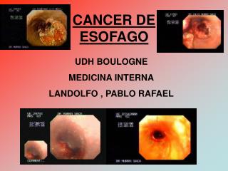 CANCER DE ESOFAGO