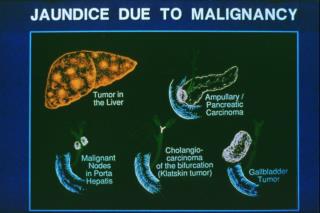 Pancreatic Cancer