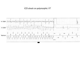 ICD-shock on polymorphic VT