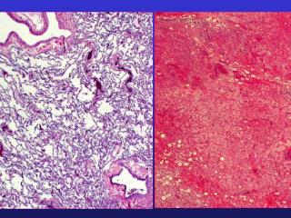 Metastatic Lung Mass