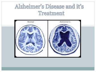 Alzheimer’s Disease and it’s Treatment
