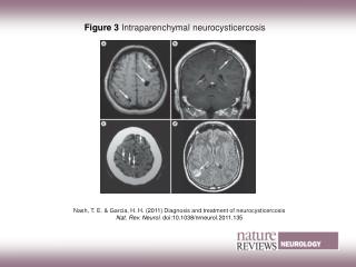 Figure 3 Intraparenchymal neurocysticercosis