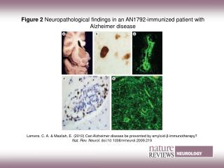 Figure 2 Neuropathological findings in an AN1792‑immunized patient with Alzheimer disease