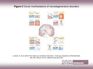 Figure 2 Ocular manifestations of neurodegenerative disorders
