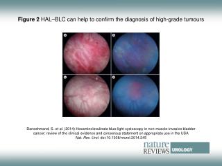 Figure 2 HAL–BLC can help to confirm the diagnosis of high-grade tumours