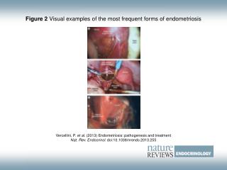 Figure 2 Visual examples of the most frequent forms of endometriosis