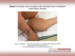 Figure 5 Urticarial rash of a patient with neonatal-onset multisystem inflammatory disease